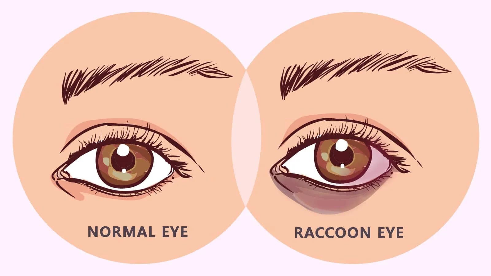 Medical illustration comparing a normal eye to a raccoon eye, showing dark, bruise-like discoloration under the lower eyelid.