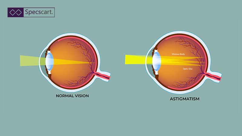 Astigmatism and its Effects, Symptoms and Treatment A clear side-by-side diagram illustrating light entering the eye: focusing sharply on the retina for Normal Vision, versus scattering across the retina for Astigmatism.