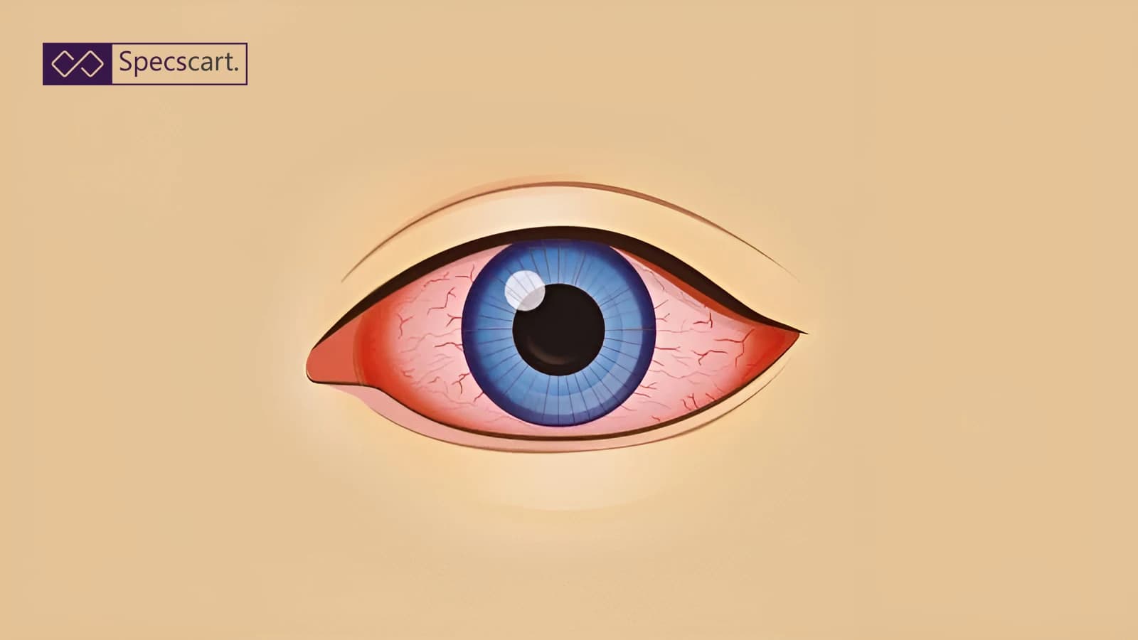 What You Should Know About Bloodshot Eyes (Red Eyes)? Illustration of a blue eye with red, bloodshot whites and visible veins against a neutral tan background.
