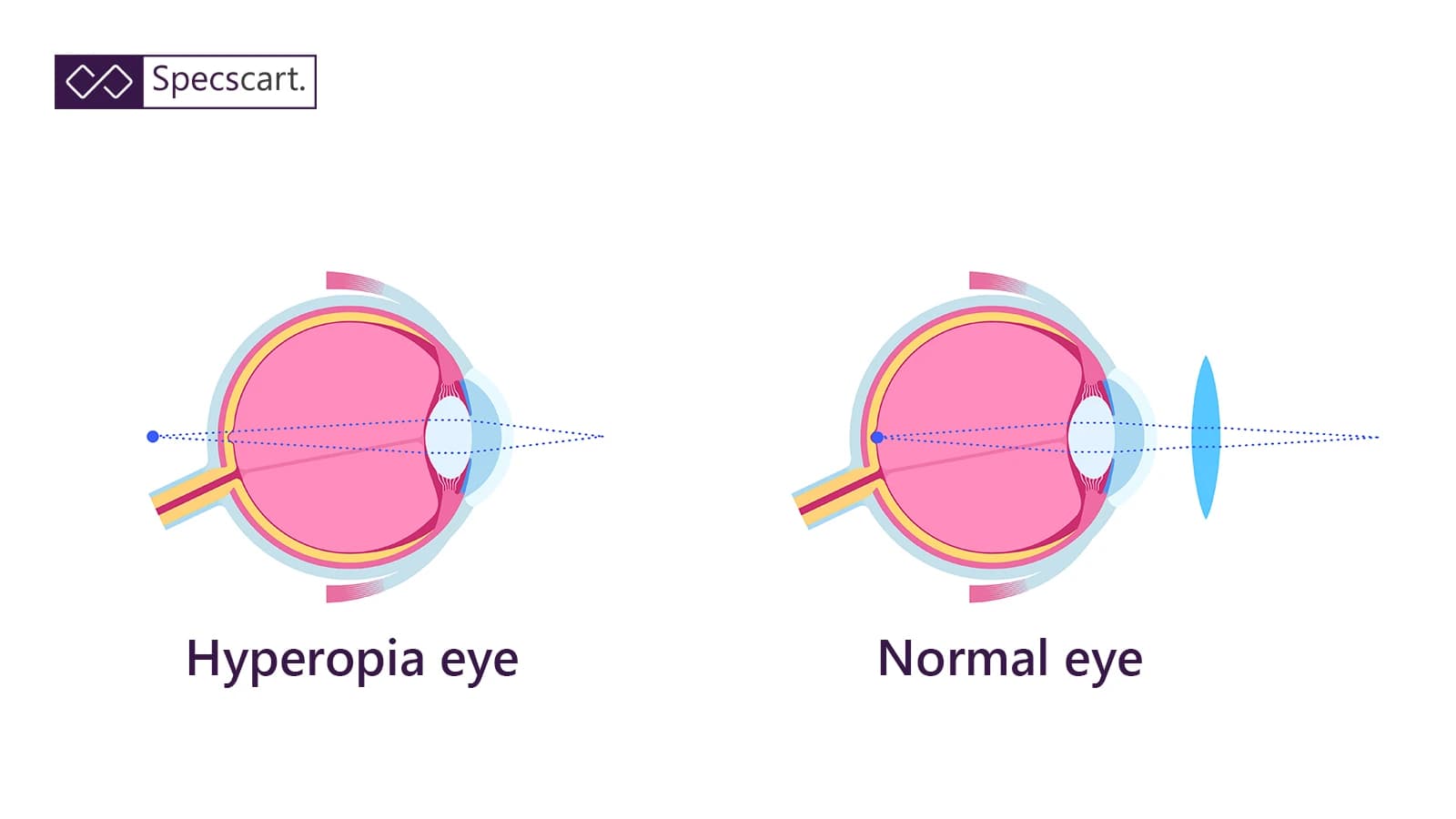 What Is Hyperopia (Farsightedness)? Causes, Symptoms & Treatment What Is Hyperopia (Farsightedness)? Causes, Symptoms & Treatment