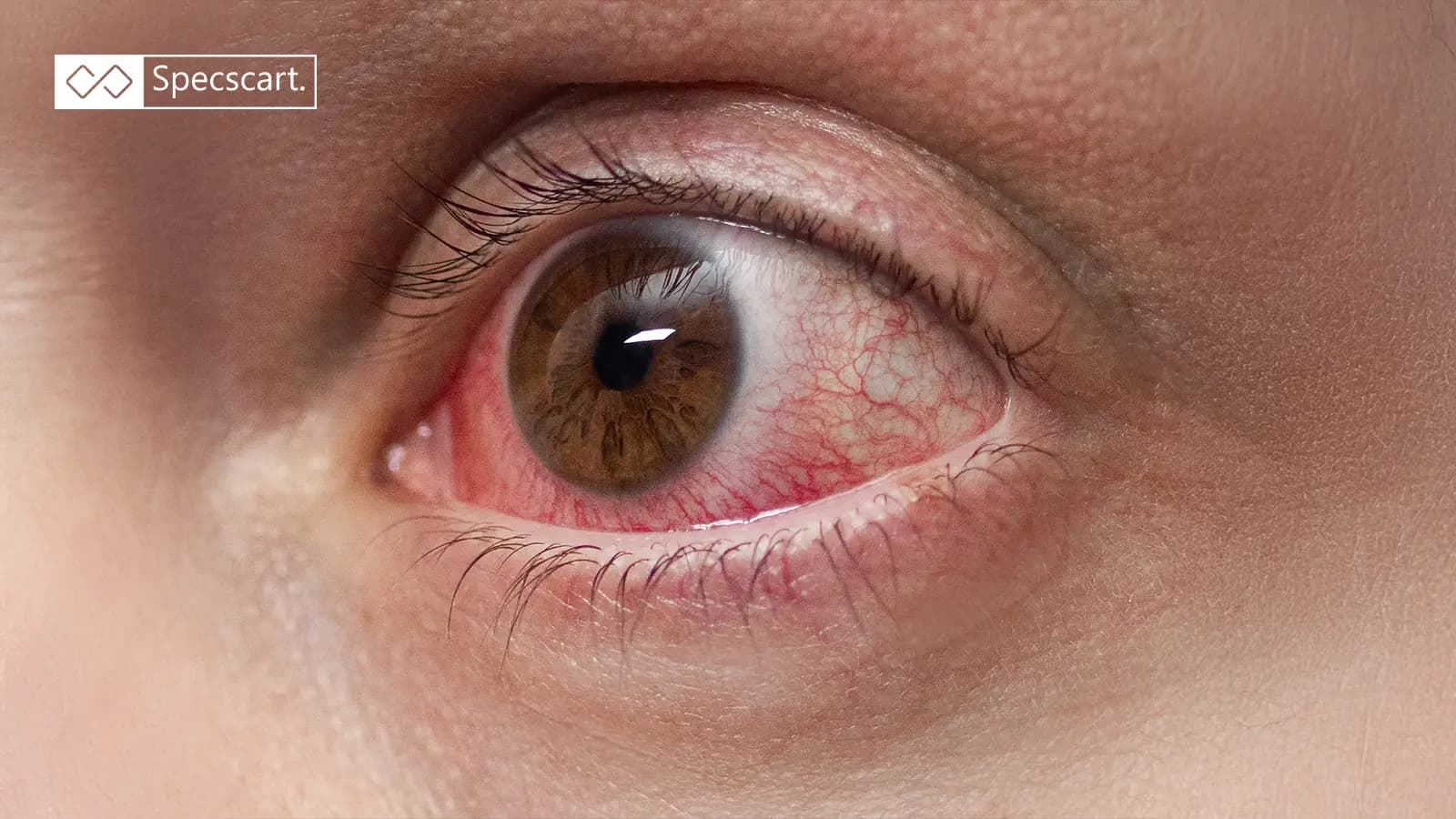 Getting to Know Eye Cold - Symptoms, Treatment and Prevention Getting to Know Eye Cold - Symptoms, Treatment and Prevention