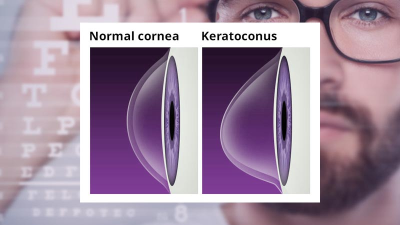 Keratoconus: Symptoms, Causes & Treatment