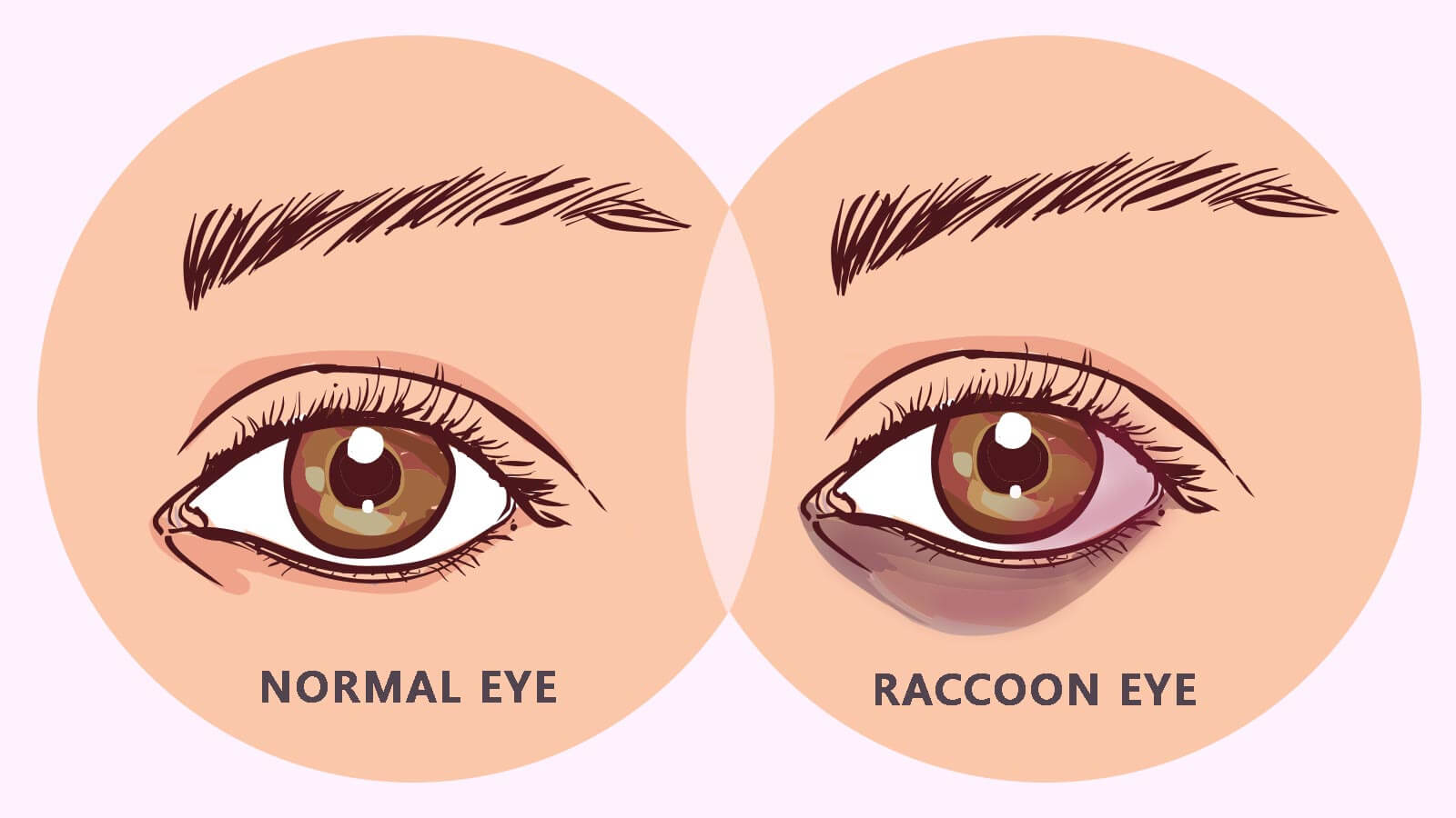 Getting to Know Everything About the Raccoon Eyes Condition