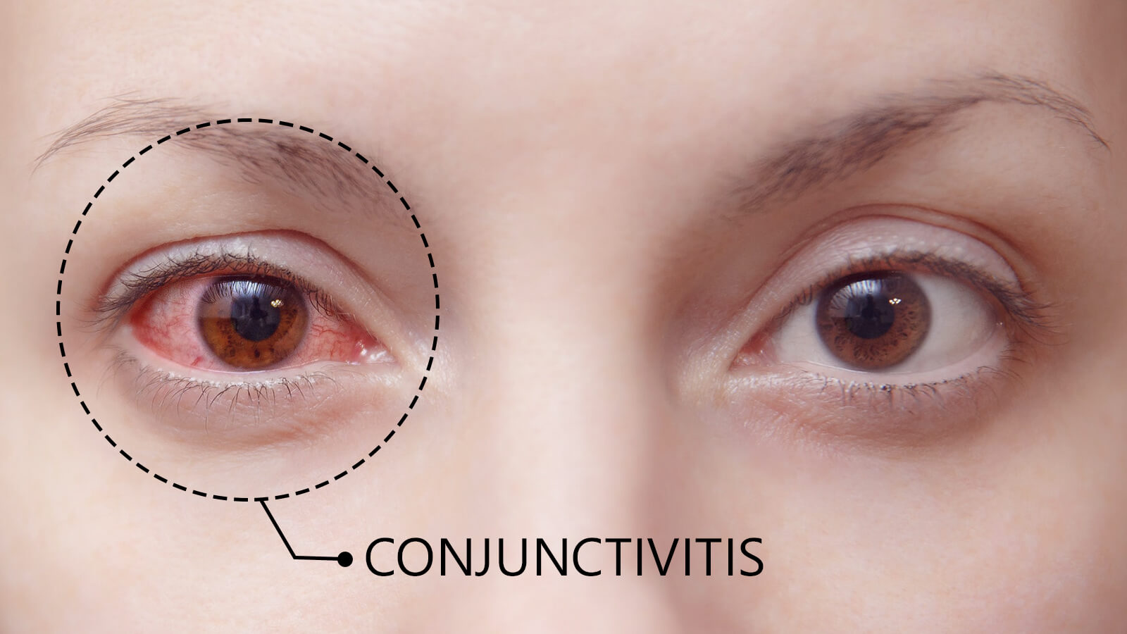 Getting to Know Conjunctivitis - The Pink Eye Disease in Detail.