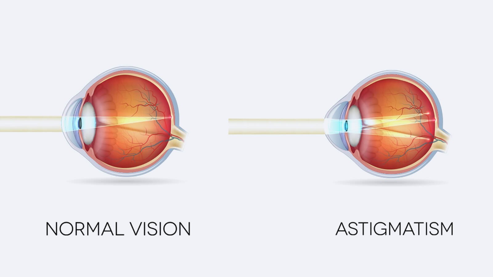 Astigmatism and its effects, symptoms and Treatment