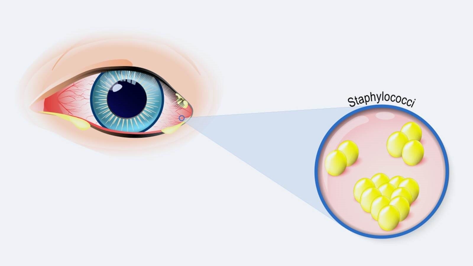 What is eye discharge: why does it develop around the eye?