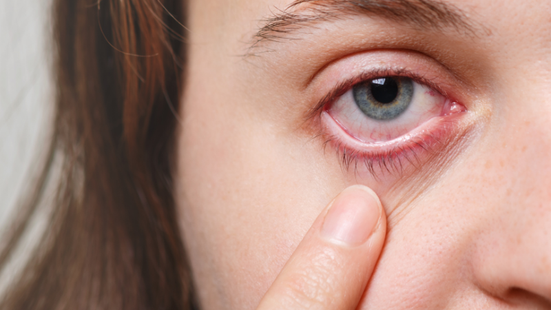 Conjunctivitis May Be One Of The Symptoms Of COVID-19!