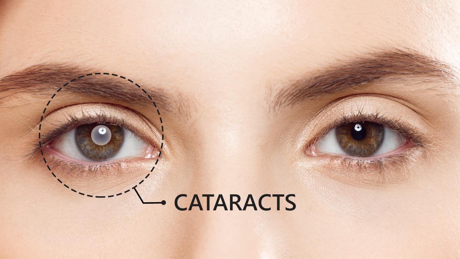 Cataract Symptoms 