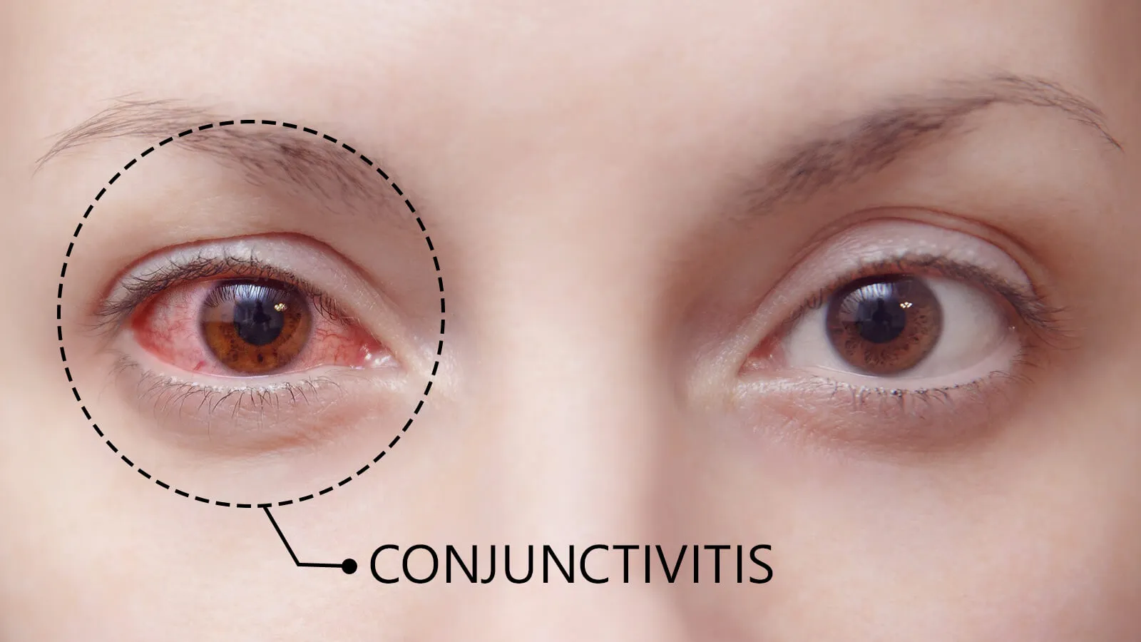 Getting to Know Conjunctivitis - The Pink Eye Disease in Detail.