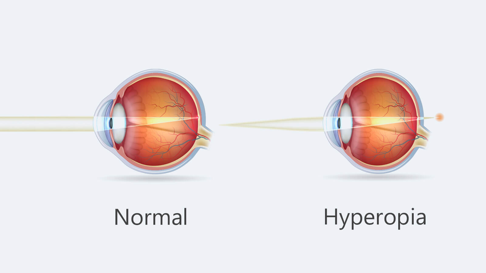 Myopia és hyperopia gyakorlatok