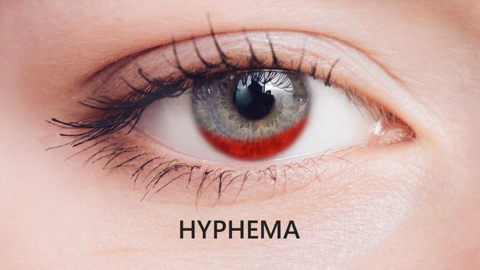 Get to Know Hyphema: Causes, Symptoms, Diagnosis and Treatment?