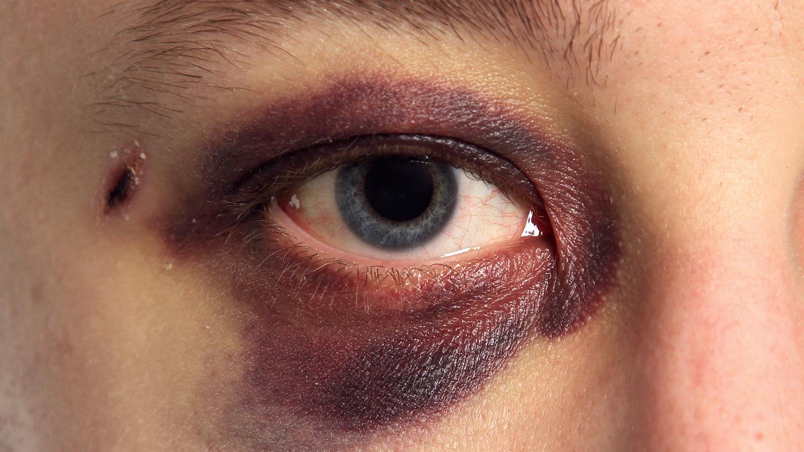 How to get rid of a black eye: Remedies and treatments