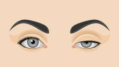 Ptosis: Everything you need to know about eyelid drooping