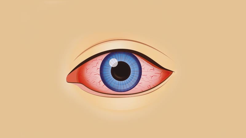 Bloodshot Eyes (Red Eyes): What should you know about this problem?