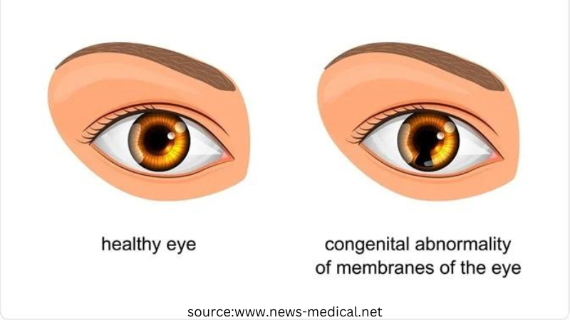 Coloboma Iris