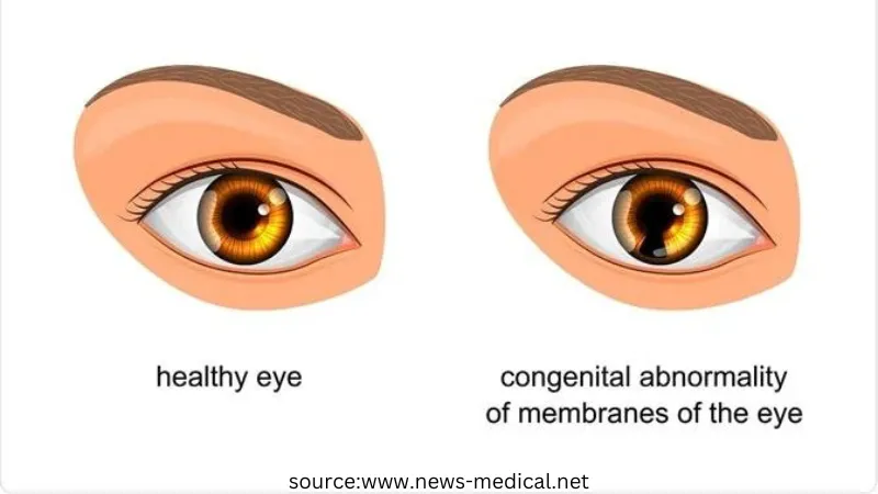 Coloboma: An eye condition before birth: Causes, Treatment, and Symptoms