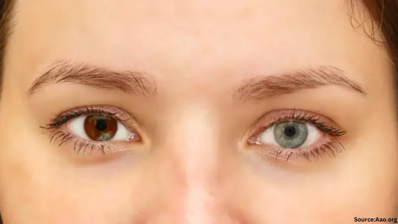 Heterochromia: The Science Behind Your Beautifully Mismatched Eyes