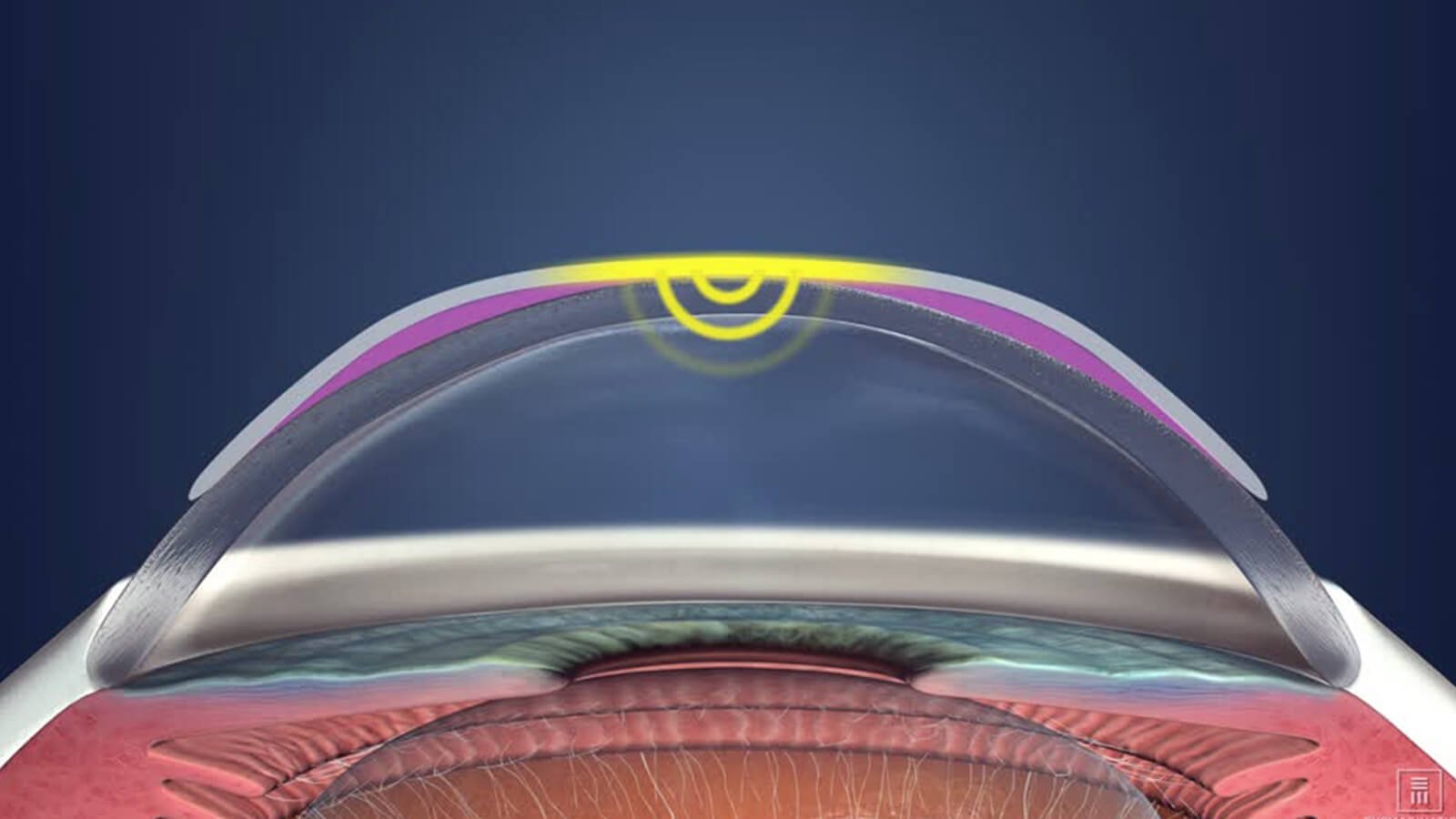 Corneal Refractive Therapy
