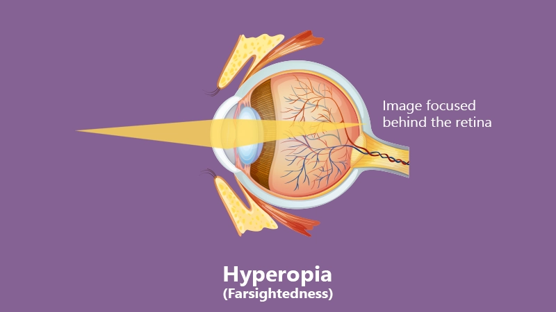 Best frame shapes for hyperopia or farsightedness