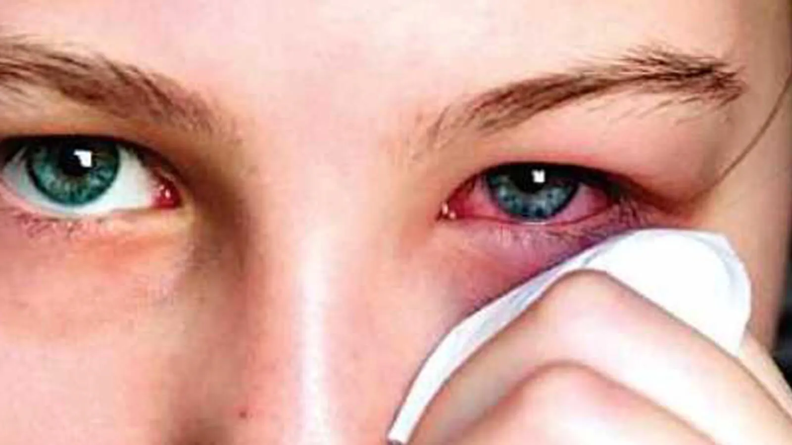 smoking causes eye infections