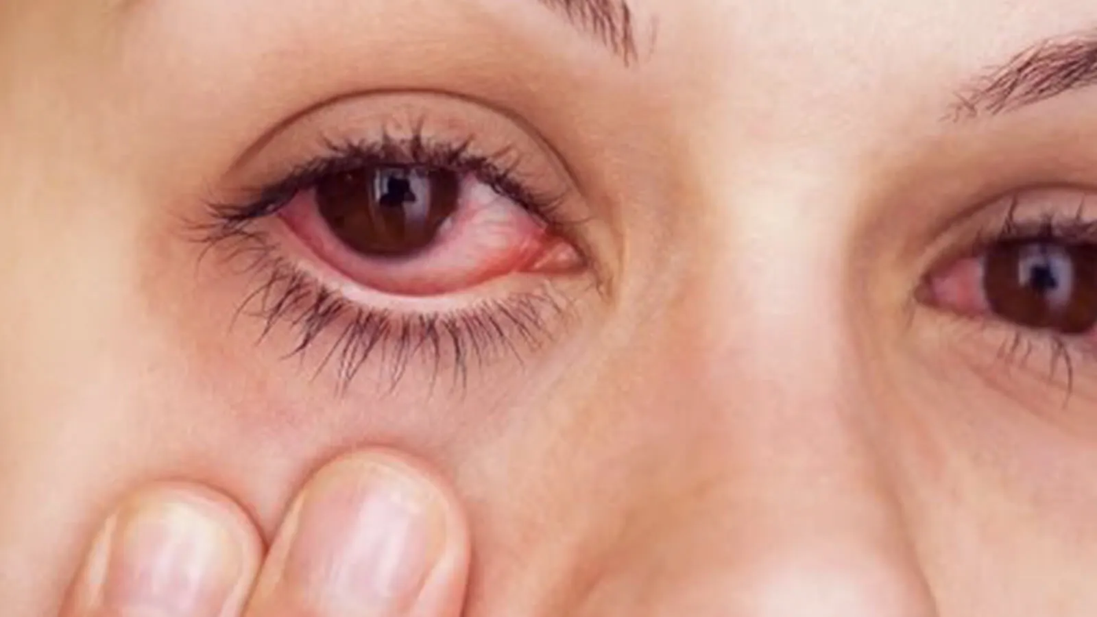smoking causes pink eyes