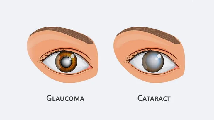 Image of eyes affected by glaucoma and cataract