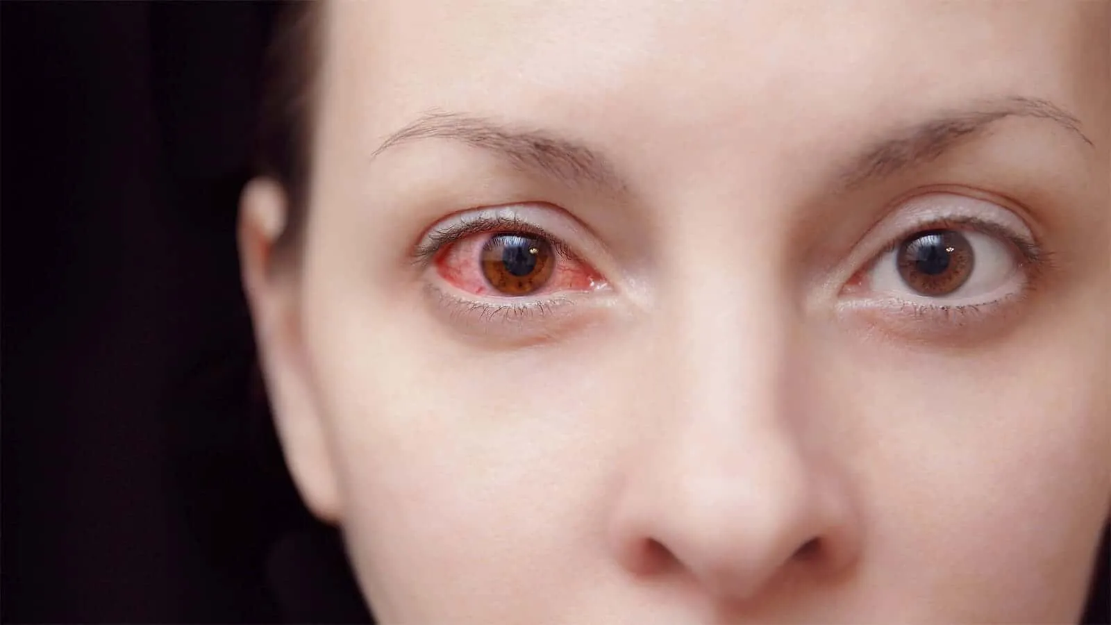 Conjunctivitis or Pink eyes