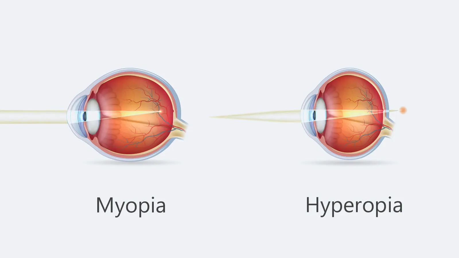 Myopia vs Hyperopia