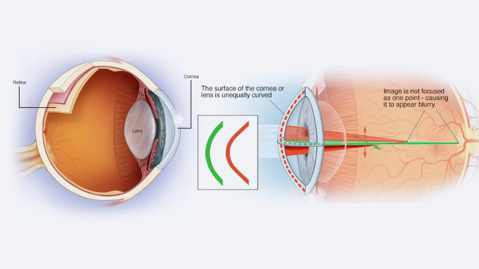 causes astigmatism