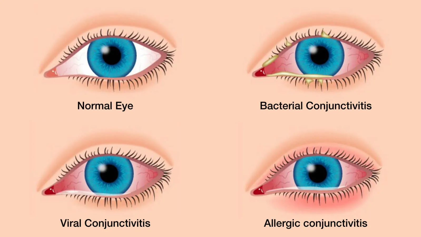 primary conjunctivitis types