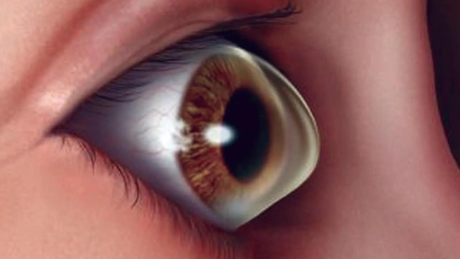 Keratoconus