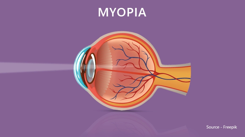 Are Multifocal Lenses Good for Myopia?