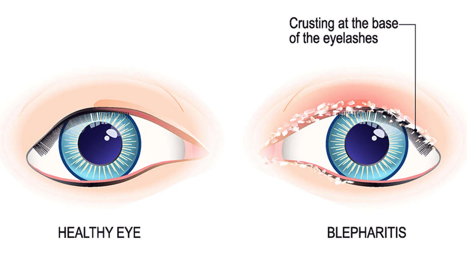 Symptoms of Blepharitis