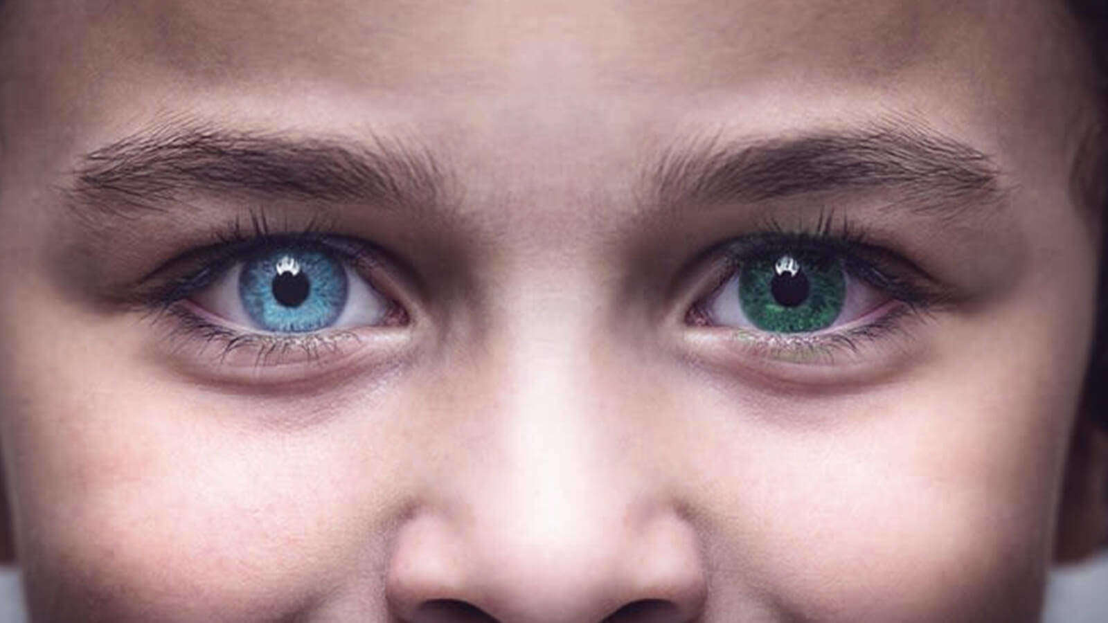 What Causes Heterochromia – And is it a Concern? - Atlantic Eye