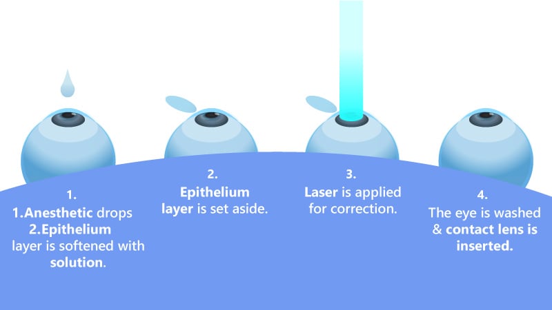 What Is LASIK Treatment?