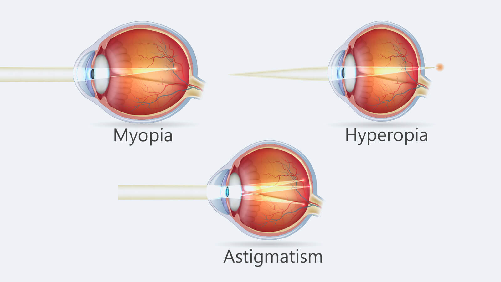 Myopia Hyperopia Astigmatism