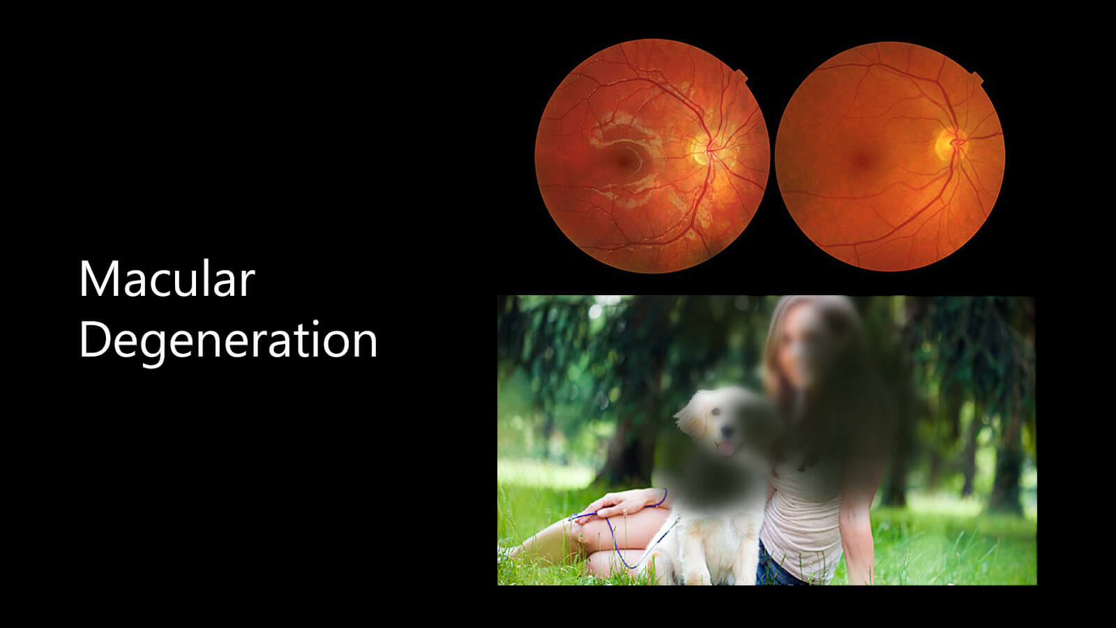 Macular Degeneration, Its cause, treatment and symptoms?