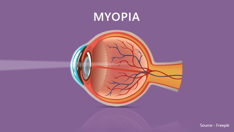 Choosing the right glasses for myopia or nearsightedness