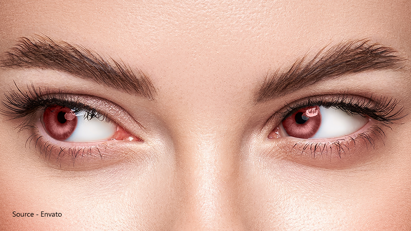 What Causes Red or Purple Eye?