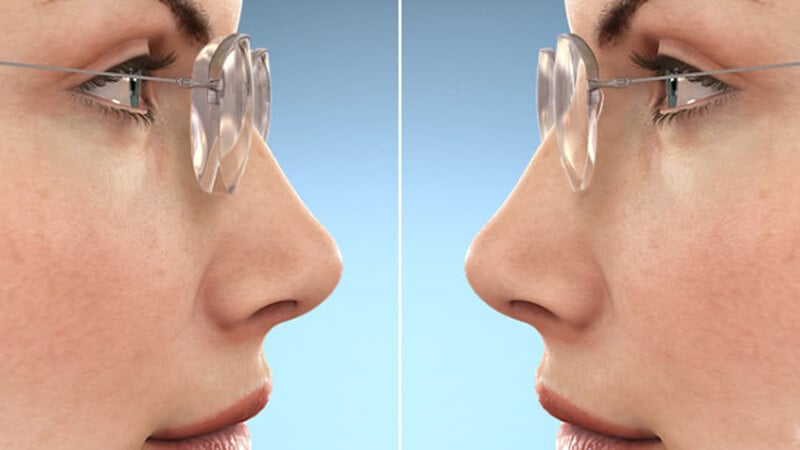 High index lenses make eyes look smaller