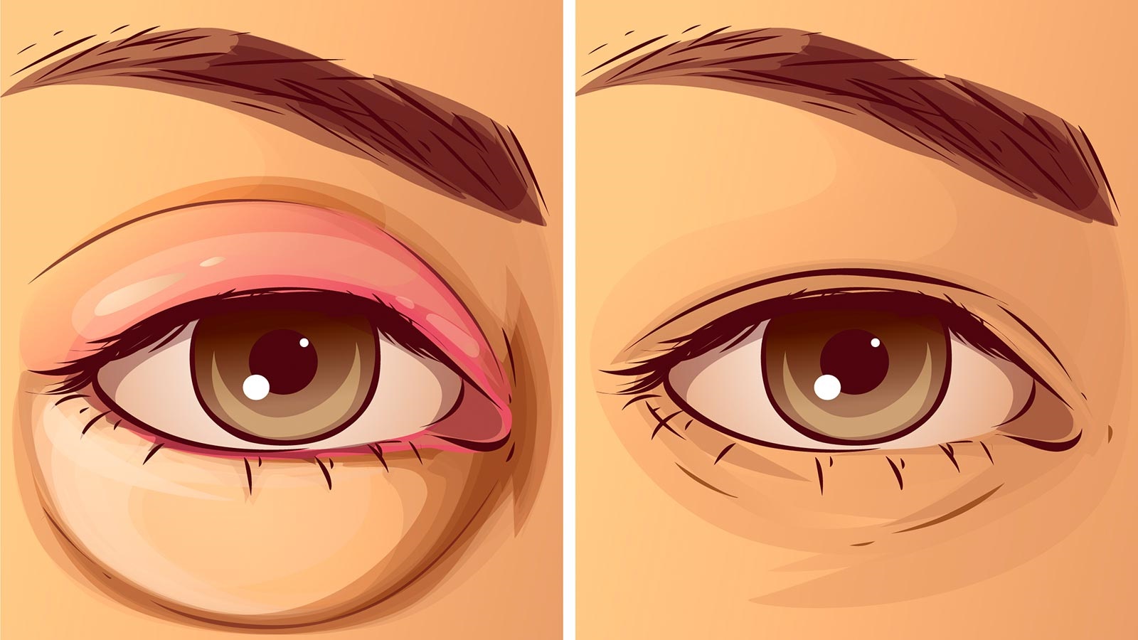 Find The Cause And Treatment Of Swollen Eyelids 